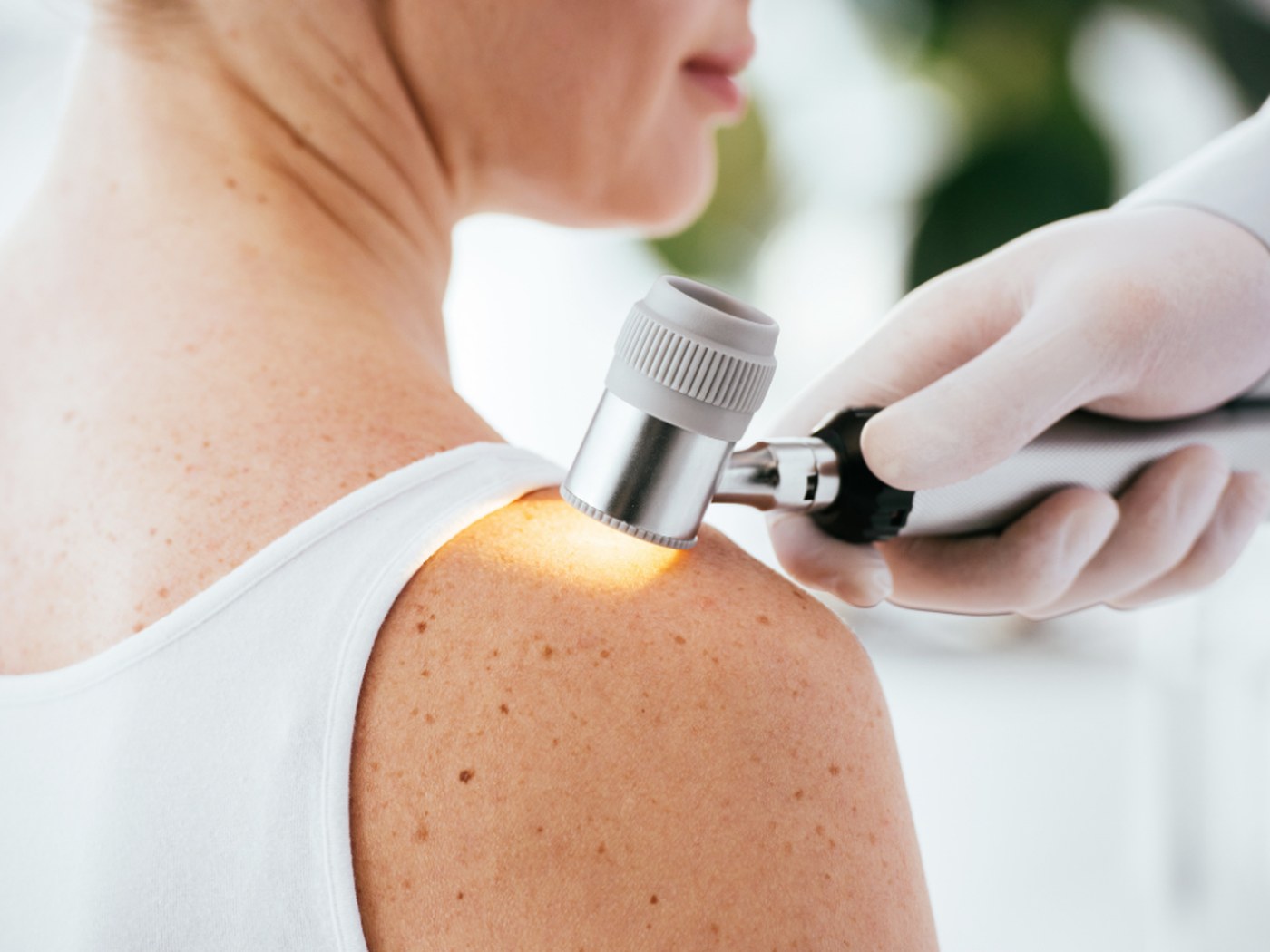 Avaliação dermatológica de manchas de melasma